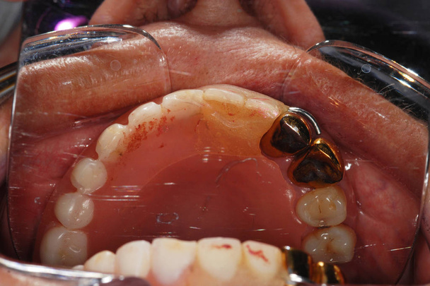 Traitement dentaire à la clinique dentaire. Restauration des dents. Installation d'implants dentaires en céramique. Couronne en métal sur les dents. Examen des dents chez le dentiste. Élimination des caries
 - Photo, image