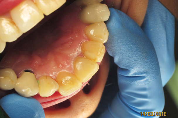 gesunde Zähne beim Menschen. Plaque-Entfernung in der Zahnklinik. Behandlung von Karies beim Zahnarzt. Installation von Zahnimplantaten. Keramikprothesen bei einem Patienten - Foto, Bild