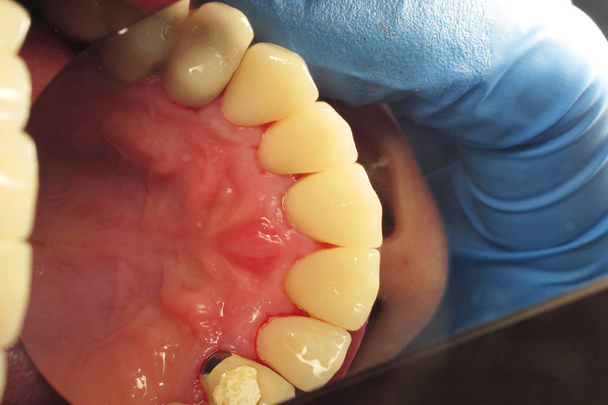 Gezonde tanden bij de mens. Verwijdering van plaque in de tandheelkundige kliniek. Behandeling van cariës bij de tandarts. Het installeren van tandheelkundige implantaten. Keramische kunstgebitten bij een patiënt - Foto, afbeelding