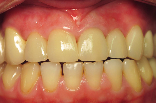 İnsanlarda sağlıklı dişler. Diş kliniğinde plak çıkarılması. Diş hekiminde diş çürüklerinin tedavisi. Diş implantları kuruyor. Hastada seramik protezler - Fotoğraf, Görsel