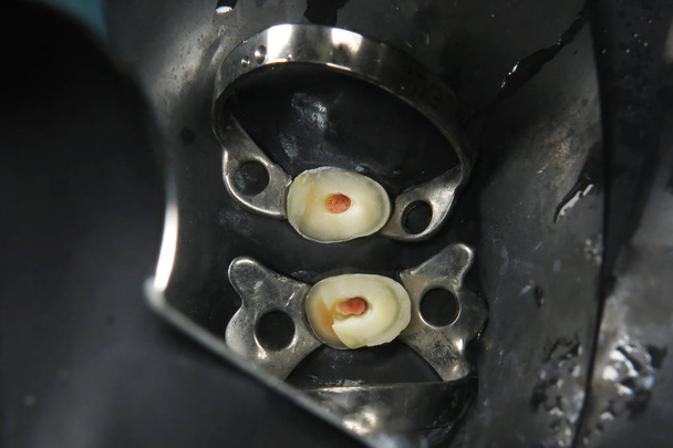 Remove the old fillings in the tooth. Treatment of bad teeth in the dental clinic. Restoration of molars. Dental metal clamps to seal sick teeth - Photo, Image