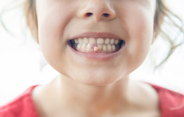 The kid had a baby tooth. Selective focus. - Photo, Image
