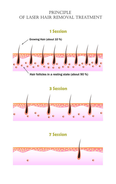 Vector illustarion that shows why it is impossible to remove all unwanted hair in one laser treatment session. Growing and resting hair follicles before the first, third, and seven session. - Vector, Image