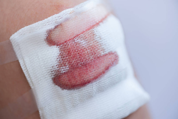 Close up of scraped human Knee with gauze and blood  - Fotó, kép