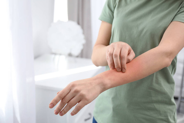 Woman with allergy symptoms scratching forearm indoors, closeup. Space for text - Fotografie, Obrázek