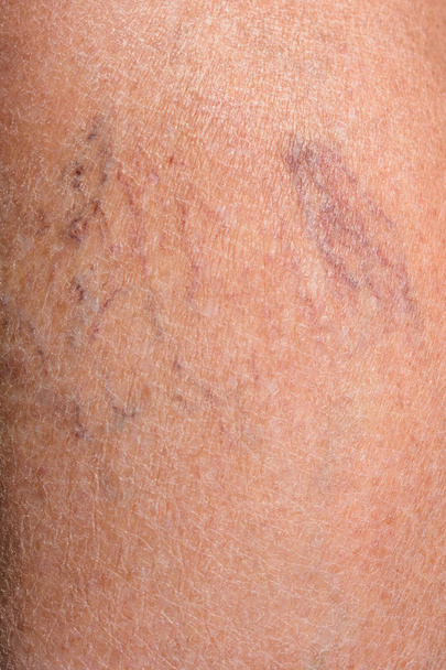 Zblízka na nohu staré ženy, která vyvíjí chorobu křečové žíly - Fotografie, Obrázek