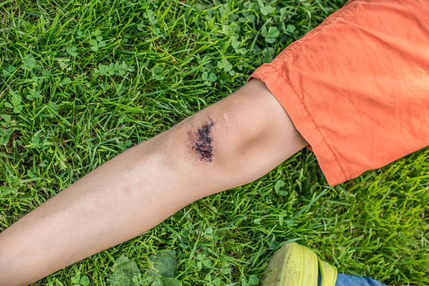 Een gewonde knie van een kind in oranje shorts liggend in het gras. - Foto, afbeelding