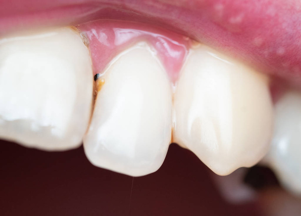 Fechar a placa dental nos dentes do homem causada pelo resíduo de café
 - Foto, Imagem