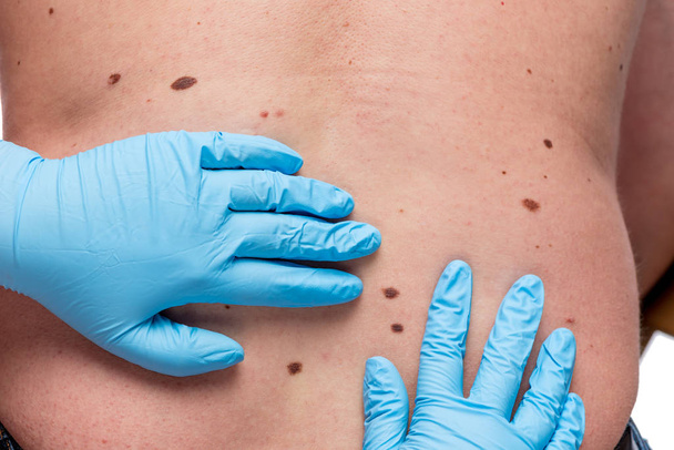 Dermatologist looking ar birthmark on patient - Фото, зображення