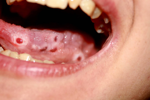 Amphotoid stomatitis. Candidiasis of the tongue. Ulcer on the tongue. Candida fungus. - Photo, Image