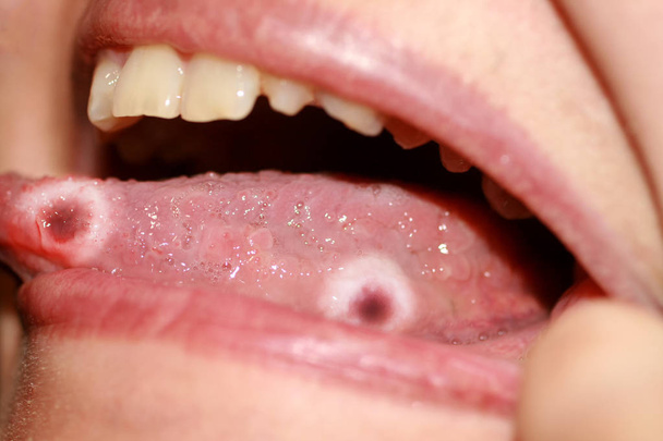Amphotoid zapalenie jamy ustnej. Kandydoza języka. Wrzód na języku. Grzyb Candida. - Zdjęcie, obraz