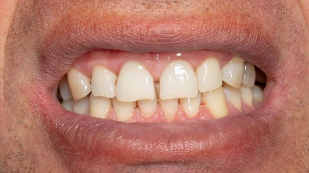 Menschliche Zähne mit rauchendem Belag und Zahnstein. Nahaufnahme Makro in de - Foto, Bild
