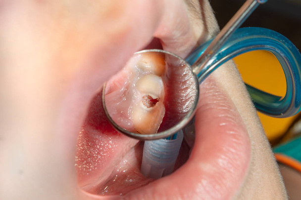lidské zuby s karí a dutinou. Zavřít makro v zubním CLI - Fotografie, Obrázek