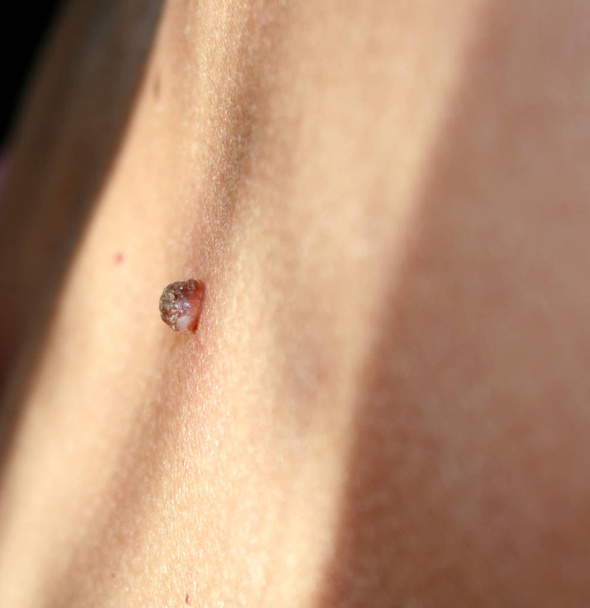 Birthmark on the skin Papiloma on the body - Photo, Image