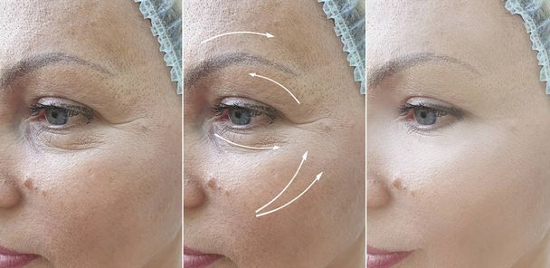 nő arc ráncok előtt és után korrekciós eljárások, kollázs - Fotó, kép