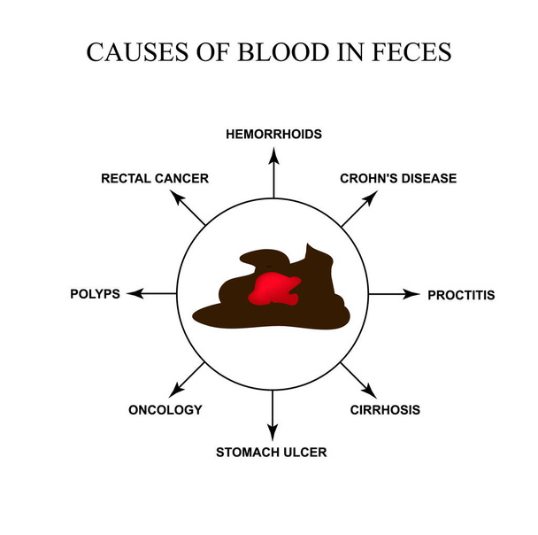 Oorzaken van bloed in de ontlasting. Ziekten van het maagdarmkanaal. Infographics. Vector illustratie op geïsoleerde achtergrond. - Vector, afbeelding