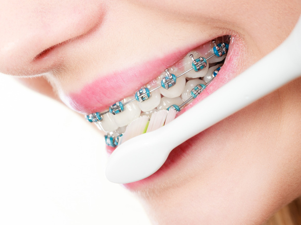 Frau putzt Zähne mit Zahnspange mit Bürste - Foto, Bild
