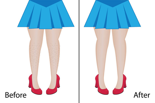 Usuwanie włosów nogi depilacji wynik przed i po zabiegu  - Wektor, obraz
