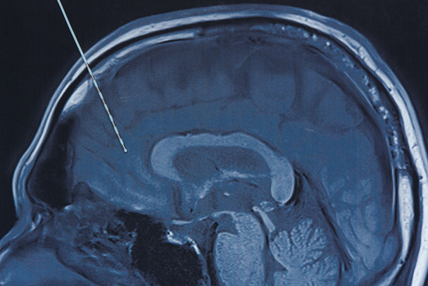 Mélység elektróda az agy MRI képalkotó. - Fotó, kép