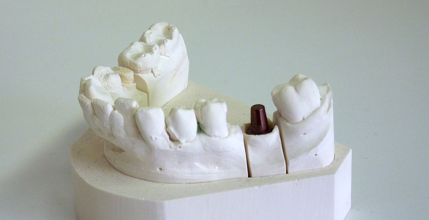 fogászati implantátum támfal - Fotó, kép