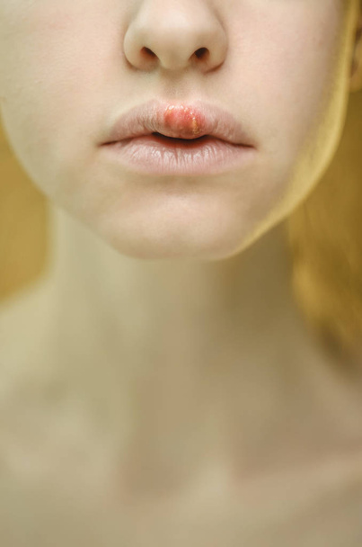 Herpes on the Upper Lip of a Young Woman - Foto, imagen