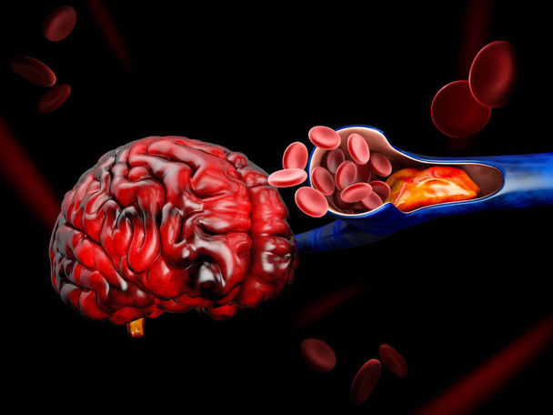 3D απεικόνιση της θρόμβωσης ή θρόμβων στο αίμα. Εμβολή - Φωτογραφία, εικόνα