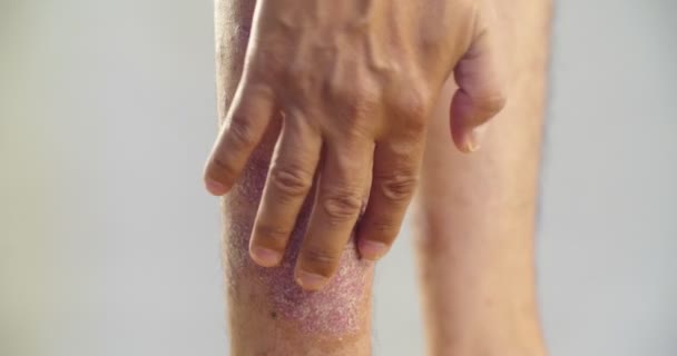 Psoriasis die knie op grijze achtergrond. 4k DCI - Video