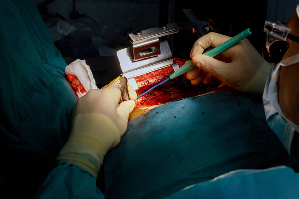 Il processo di chirurgia cardiaca strumenti chirurgici per la chirurgia a cuore aperto
 - Foto, immagini