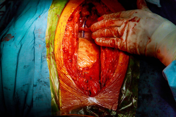 Chirurgo passa la procedura del cuore aperto
 - Foto, immagini