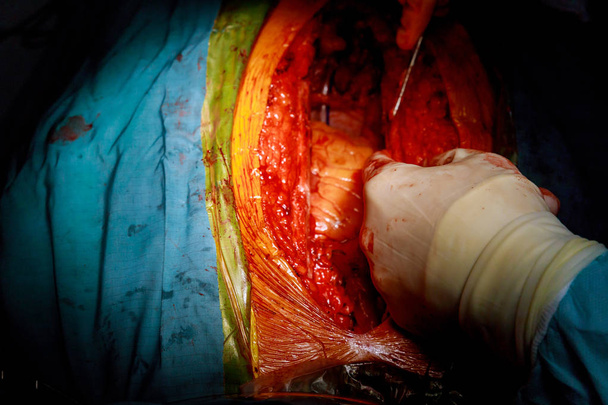 Műtét orvos sebészeti központ nyitott szívműtét - Fotó, kép