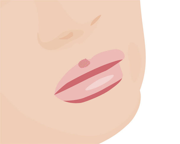 Blisters because of cold sores on lips - Vector, Image