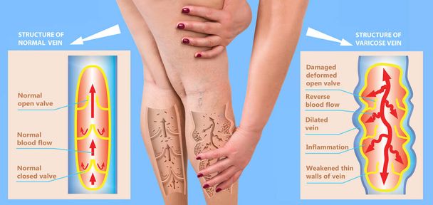 The varicose veins on a legs of woman - Photo, Image