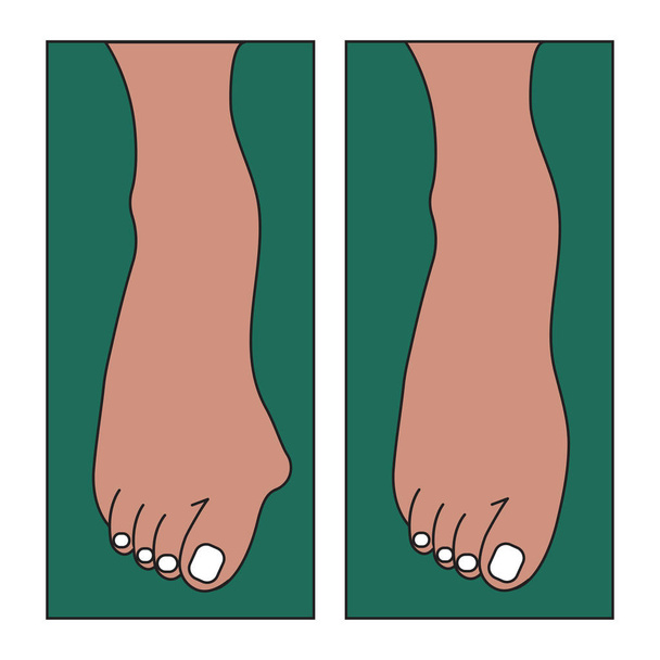Hallux valgus, foot deformation - Vector, Image