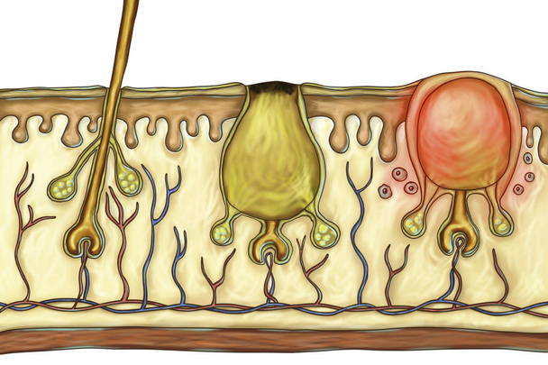 Histopatologia das lesões de acne
 - Foto, Imagem
