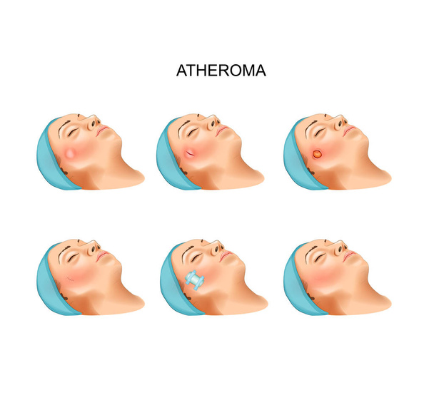 chirurgie van goedaardige tumoren van atheroma - Vector, afbeelding