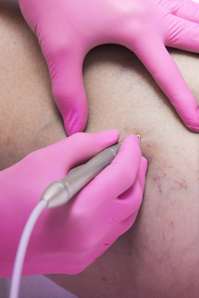 closeup of laser capillary removal procedure in medical clinic - Φωτογραφία, εικόνα