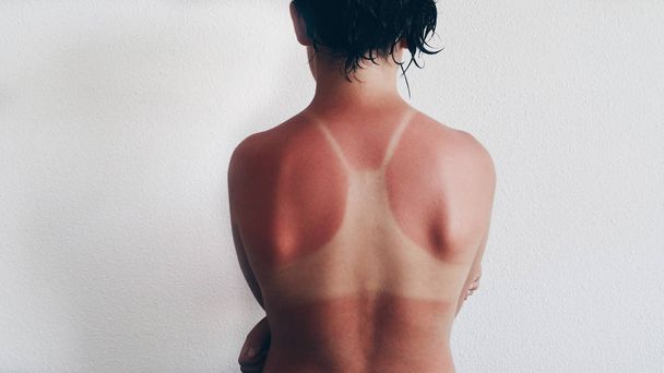 спалена дівчина шкіра на сонці
 - Фото, зображення
