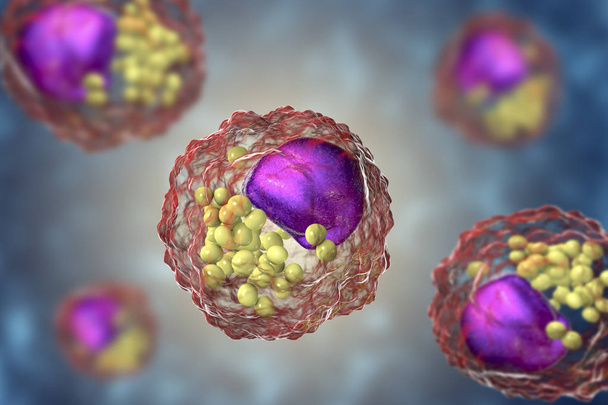 Κυψελίδα αφρού, μακροφάγα κύτταρα που περιέχουν σταγονίδια λιπιδίων - Φωτογραφία, εικόνα