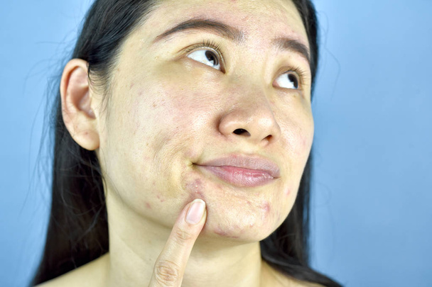 Mujer asiática dedo en el acné de cabeza blanca en la barbilla, adulto preocupación por el problema de la piel facial, arrugas, poros grandes, piel seca, cicatriz del acné, signo de envejecimiento de la piel
. - Foto, imagen