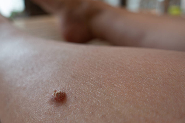 an unattractive wart has formed on the shinbone - Photo, Image
