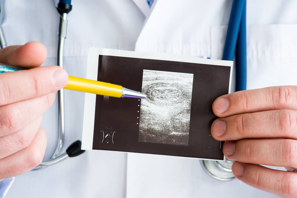 Intussusception střeva v jatrové flexře dvojtečky na fotografii konceptu ultrazvukového obrazu. Doktor ukazuje perem na tištěnou ultrazvukovou patologii. Foto pro diagnózu, radiologii, chirurgii - Fotografie, Obrázek