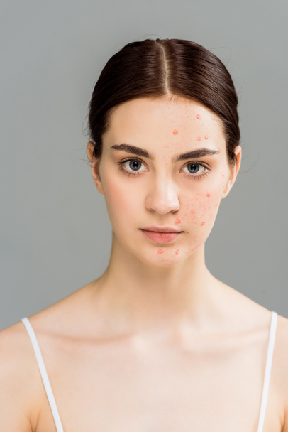woman with acne on face looking at camera isolated on grey  - Foto, immagini