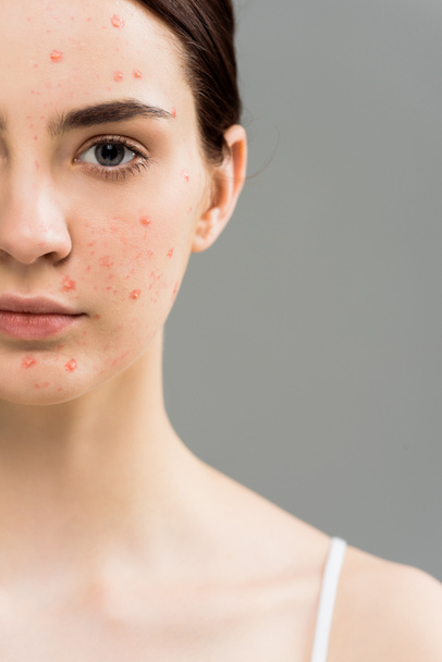 cropped view of young woman with acne looking at camera isolated on grey  - Fotografie, Obrázek