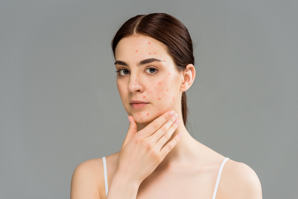 beautiful young woman with pimples touching face isolated on grey  - Fotoğraf, Görsel