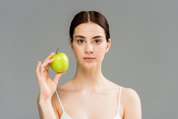  mujer joven con granos en la cara sosteniendo manzana verde aislado en gris
  - Foto, Imagen