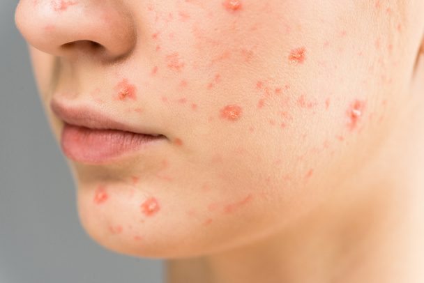 close up of young woman with pimples on face isolated on grey  - Photo, Image