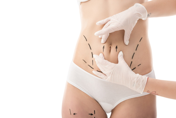 partial view of plastic surgeon in latex gloves and patient in underwear with marks on body isolated on white - Foto, Bild