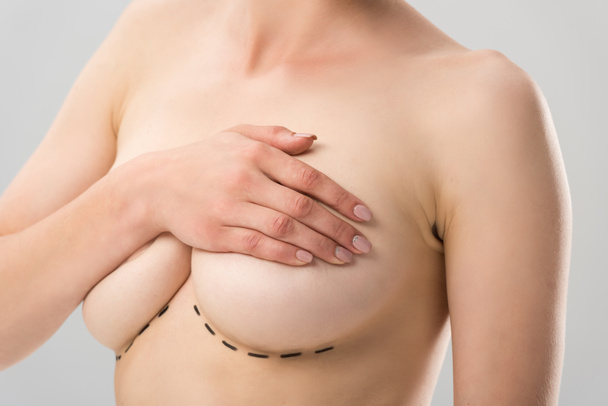 灰色で隔離された乳房の下にマークを持つ裸の女性の部分的なビュー - 写真・画像