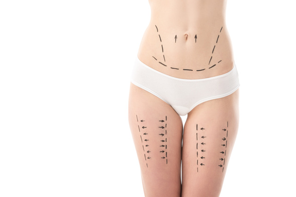 vue partielle de la femme mince en culotte avec des marques sur le ventre et les hanches isolées sur blanc
 - Photo, image