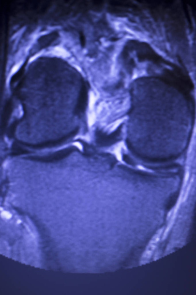 IRM examen ménisque du genou déchirure
 - Photo, image